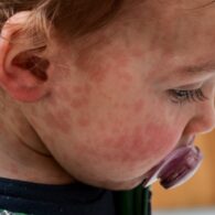 measles case in King County