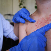 measles outbreak Snohomish County